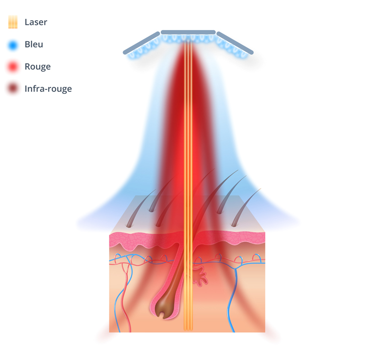 Qu’est-ce que la Photobiomodulation ?
